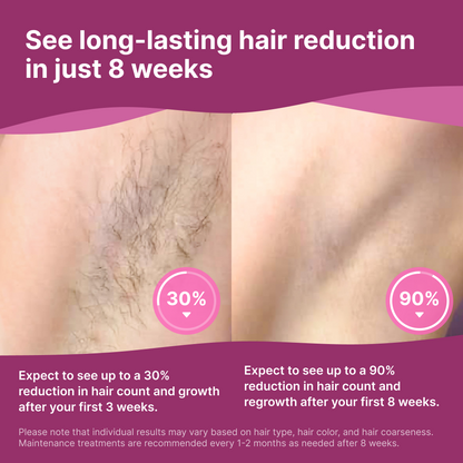 Beam At-Home IPL Hair Removal System